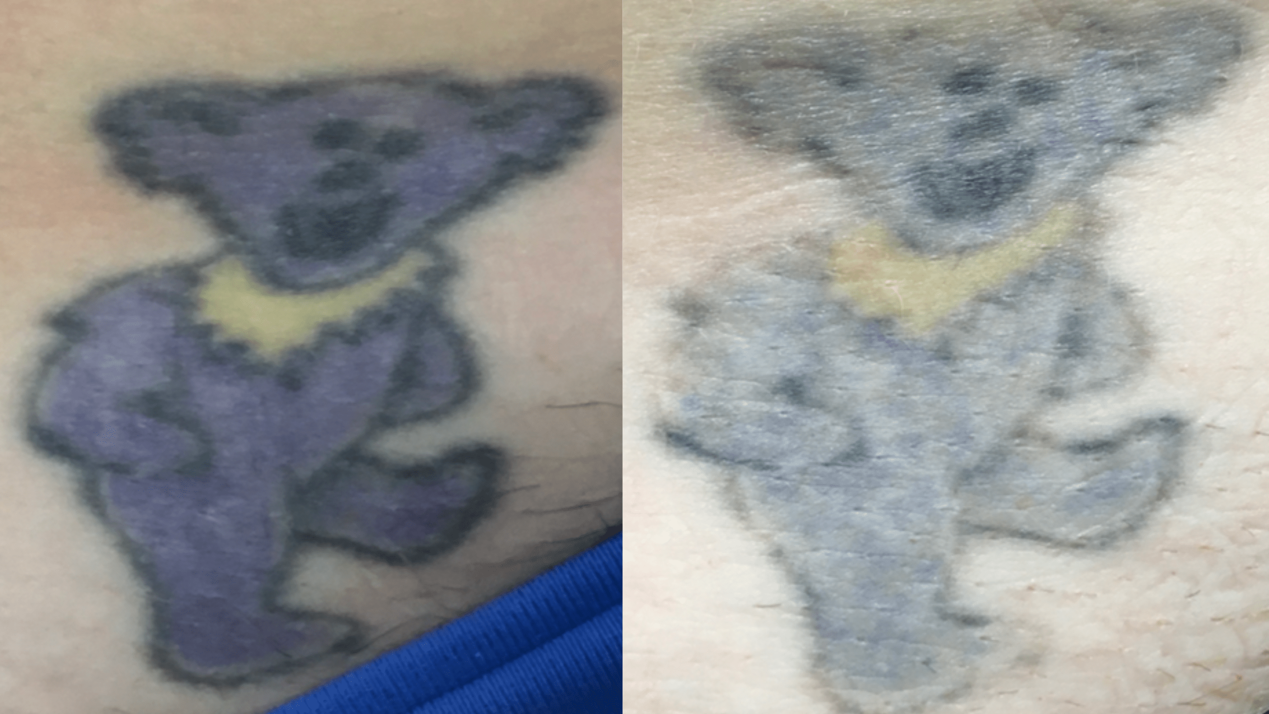 1 tx - 2 months - Old tattoos with bright colors can be easily diminished and readied for coverup.