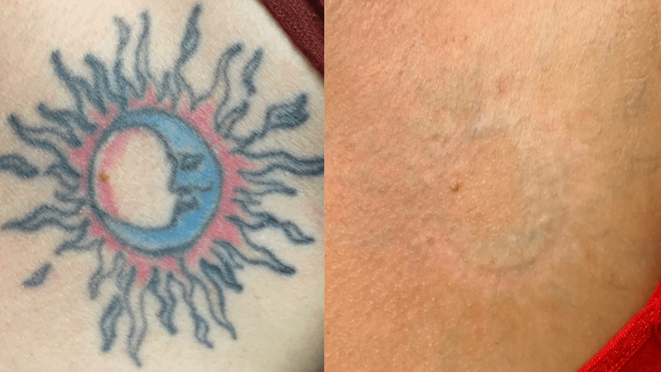 10 tx - 24 months - Sun/Moon on upper chest. Blue and red shading, with black line work. Colors can be difficult to remove. The Enlightlen 3 is equipped to target all colors, without permanently damaging the skin below. Clinical removal achieved.
