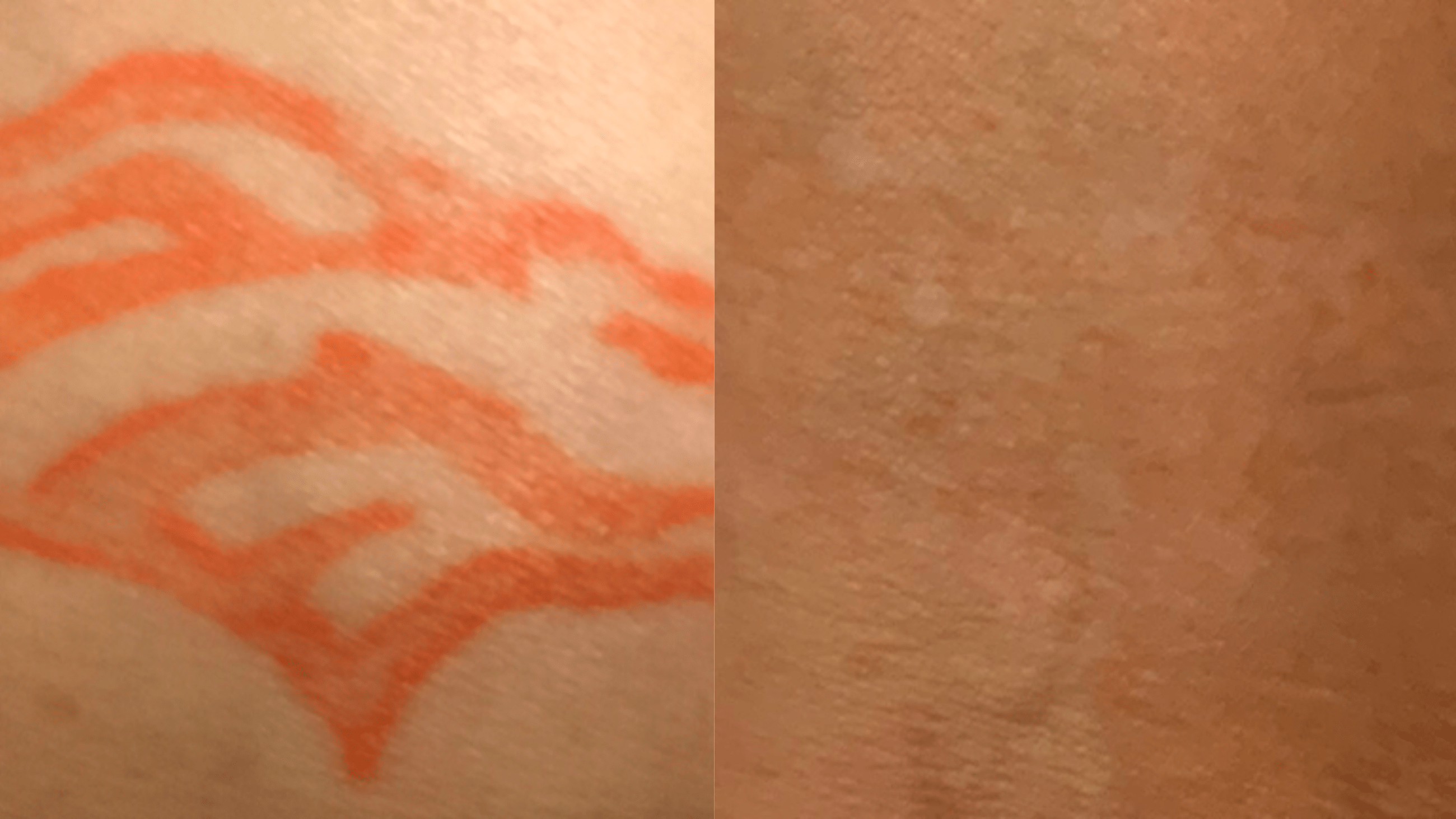 11 tx - 27 months - Bronco on inner wrist. Orange line work and shading. Orange is a difficult color to remove. Every other laser device on the market will scar the skin when attempting to remove orange. However, this patient achieved full removal, revealing healthy, uncompromised skin, below. It’s like the tattoo was never there. Full removal achieved.