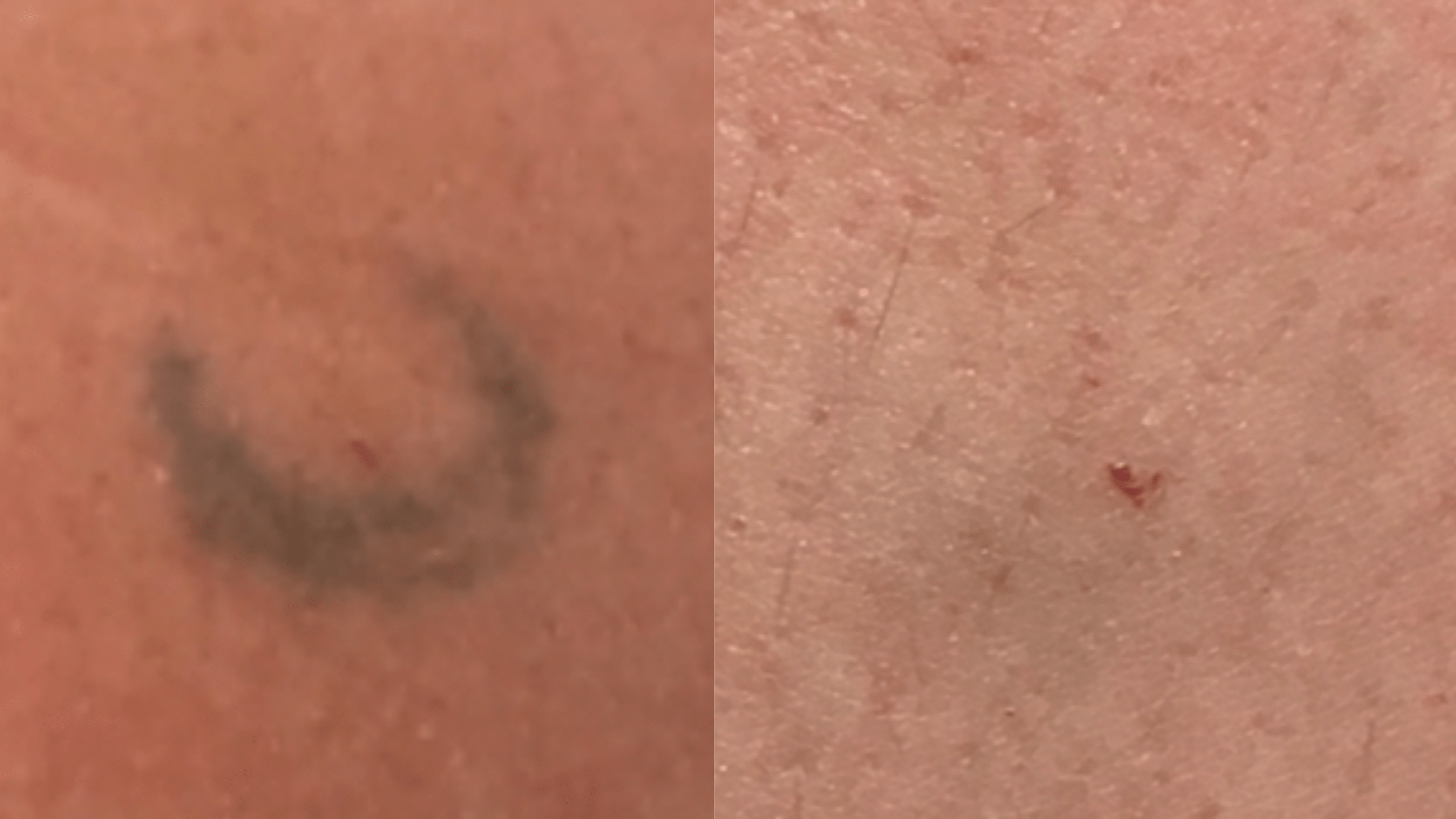 1 tx - 4 months - R upper arm. Aged, stick and poke tattoo. Required 1 treatment to remove.
