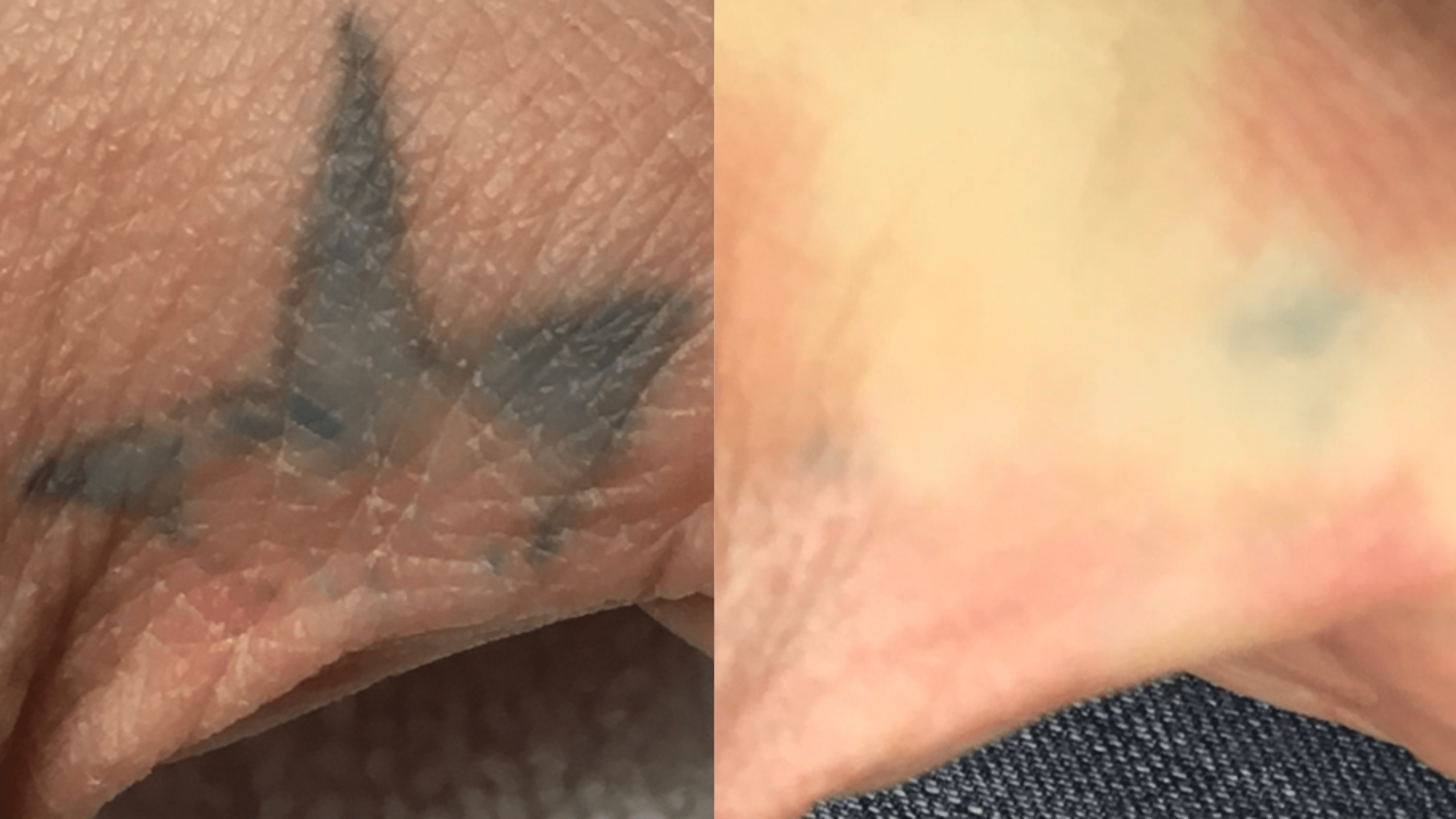 4 tx - 13 months - Normally professional hand tattoos take an average of 8-12 txs to resolve. However when the ink is amateur and very shallow, the number of necessary tx needed to diminish a tattoo can dramatically decrease.