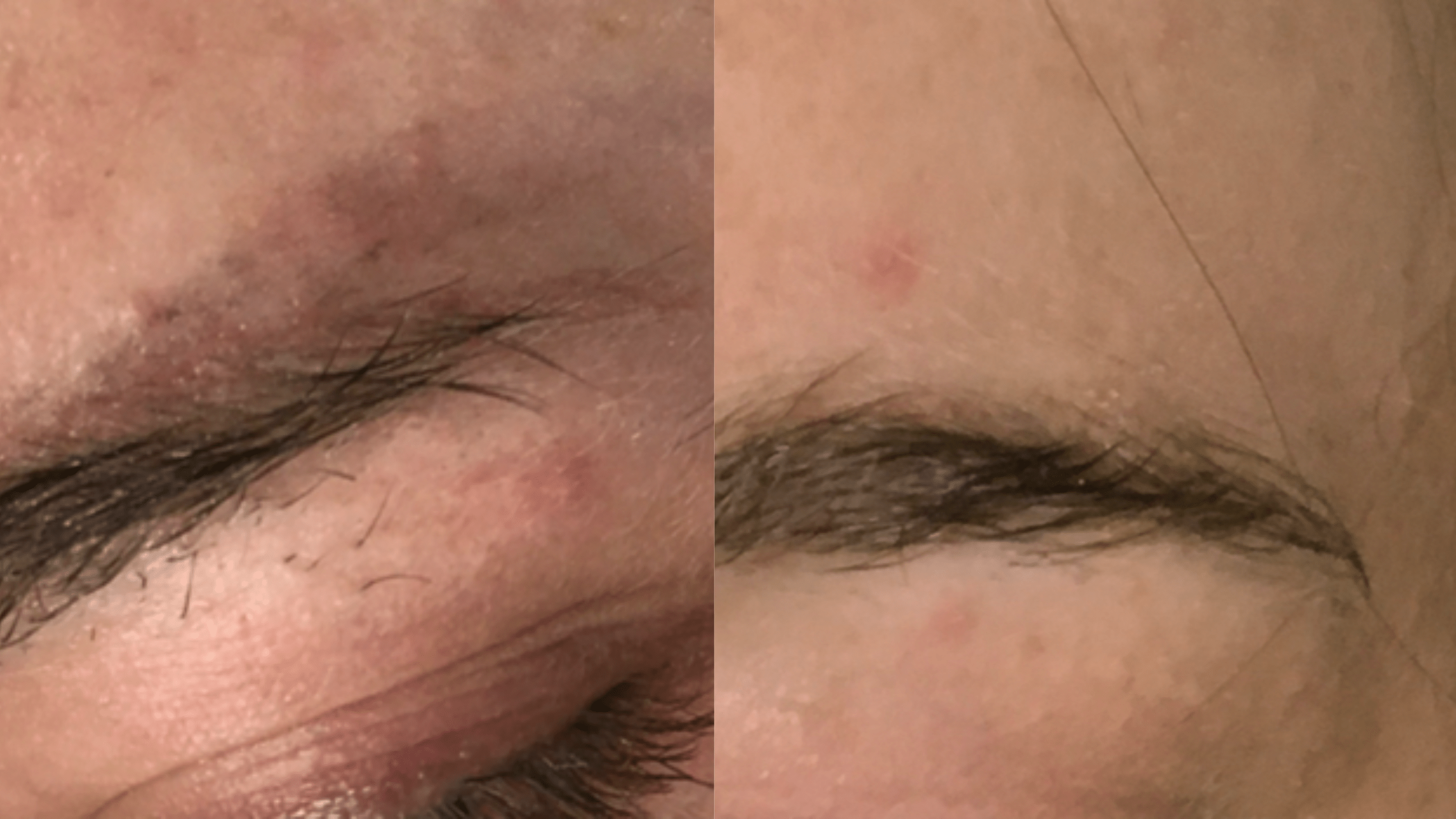 3tx - 5 months - This patient had tried everything to remove her oddly shaped microbladed brows. Including multiple glycolic peels and saline solution removal attempts. Nothing cleared the ink. In just 3 easy Enlighten txs she is now enjoying her natural brows.