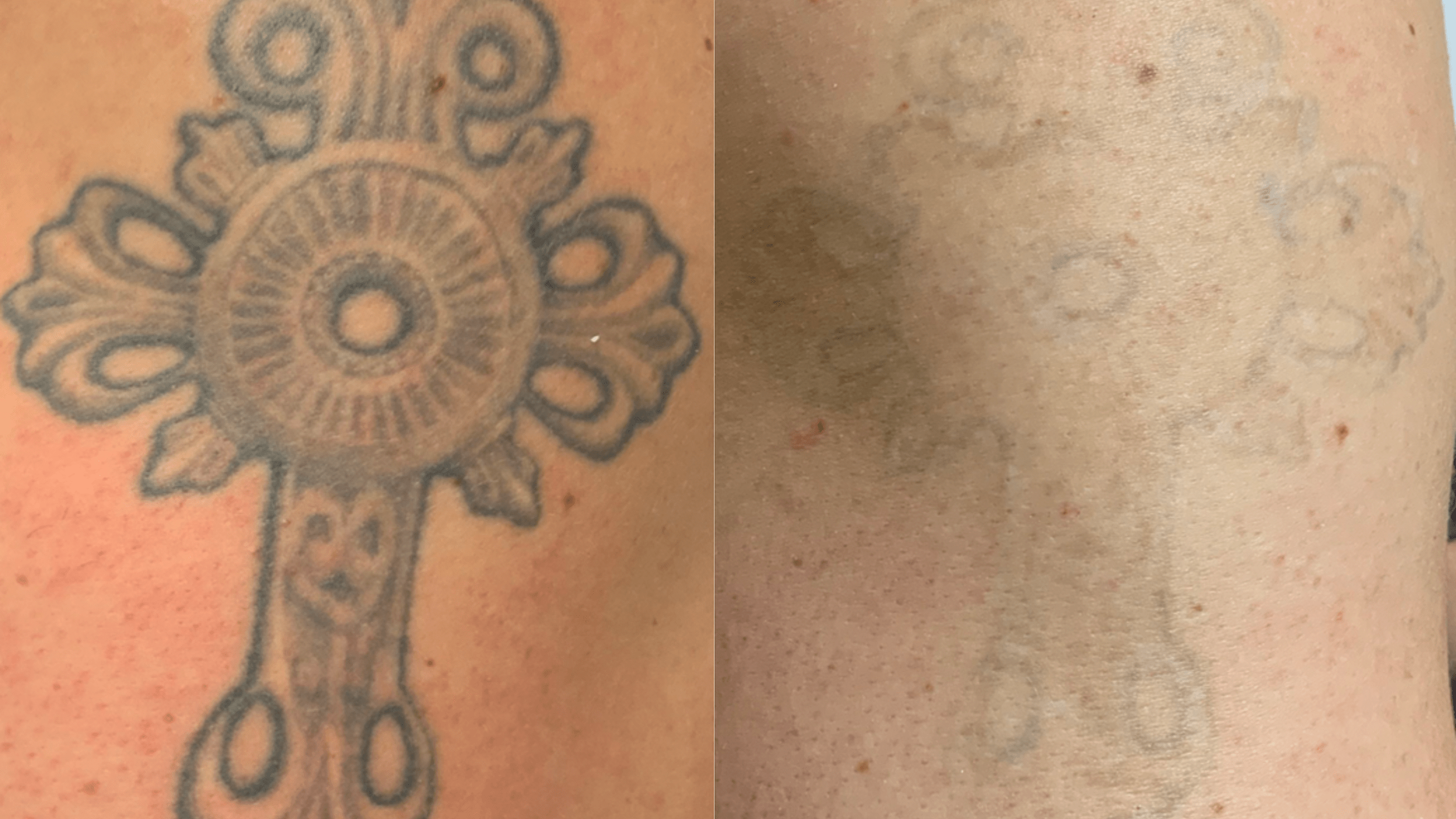 8 Tx - 16 months - It can be disheartening to get a new tattoo that you don’t love. New tattoos take longer to remove than old tattoos. This patient was removing a brand new tattoo and a 20 year old tattoo at the same time. This patient will continue tx to optimize clinical removal.
