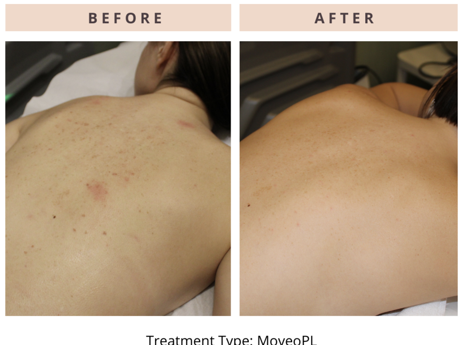 Premier Body and Laser - Motus AZ+ Laser - Before & After Photos - 5